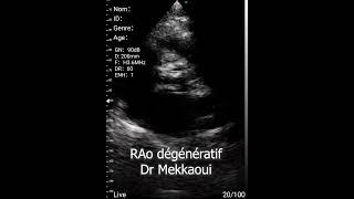 rétrécissement aortique dégénératif écho  auscultation digitale [upl. by Ahseken]