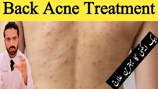 Treatment of Back Acne Shoulder Acne and Chest Acne in Urdu  Get Rid Of Back Acne  Dr Nadeem Rph [upl. by Airpal835]