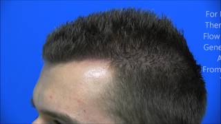 Dr Hasson Hair Transplant Surgery Hairline Restoration 2249 Grafts in 1 session [upl. by Cogan]