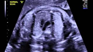 3 vessel tracheal view of a normal fetal heart [upl. by Assanav]