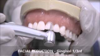 TOOTH PREPARATION FOR AN ALL CERAMIC CROWN [upl. by Nylsaj363]