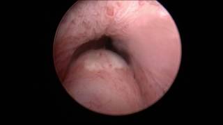 UroLift® System Office Procedure Dr Gange amp Dr Richardson [upl. by Kauffmann]