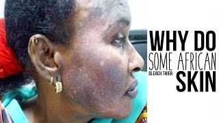 SKIN Bleaching WHY SOME AFRICANS BLEACH THEIR SKIN  Colourism [upl. by Airod]