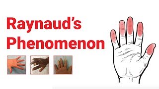 Raynaud’s Phenomenon  What You Should Know  Johns Hopkins Medicine [upl. by Sewel]