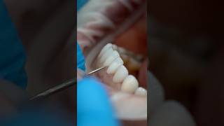 Get Perfect Teeth with Porcelain Veneers asmr dentalcosmeticturkey smilemakeover [upl. by Anamor]