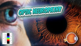 Lebers hereditary optic neuropathy Your EYEBALLS 👁️👁️💉😳💊🔊💯✅ [upl. by Dania]