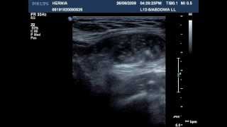 Inguinal hernia [upl. by Pudendas]