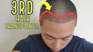 THE END OF HAIRLICIOUSLYS HAIR TRANSPLANT JOURNEY 3RD HAIR TRANSPLANT [upl. by Carlyn]