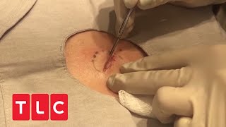 Popaholic drückt riesen Zyste aus  Dr Pimple Popper  TLC Deutschland [upl. by Kirstin140]