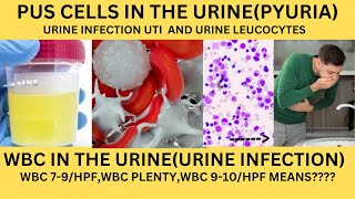 PUS CELLS IN THE URINEPYURIAWBC IN THE URINEURINE LEUCOCYTES CAUSES SYMPTOMS AND TREATMENT [upl. by Solracesoj]