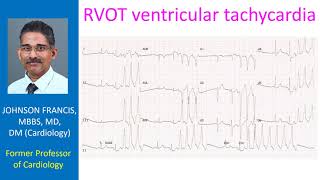 RVOT ventricular tachycardia [upl. by Slifka]