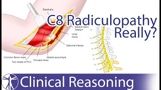 Ulnar Nerve Entrapment mimicking C8 Radiculopathy [upl. by Ahsuas130]