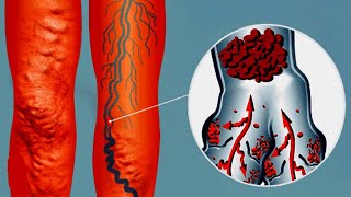 What You NEED to Know About Blood Clots Essential Information [upl. by Dennie458]