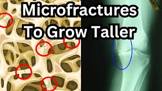 How To Grow Taller After Puberty Full Microfracture Guide with reallife examples [upl. by Nore]