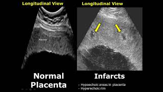 Placenta Ultrasound Normal Vs Abnormal Image Appearances Comparison  Placental Pathologies on USG [upl. by Aitnic]