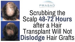 When Transplanted Hair Grafts are Secure Enough to Allow Scalp Cleaning and Scrubbing [upl. by Petronilla362]