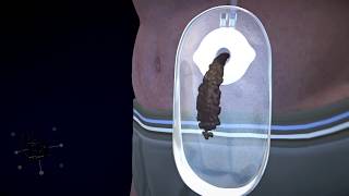 3d medical animation ostomy device design part1 [upl. by Aro]