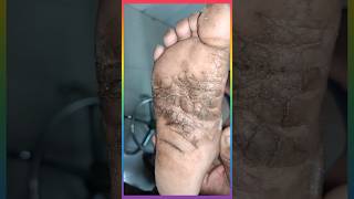 पैरो के तलवे की चमडी का रोग plantar keratoderma viralshorts [upl. by Kera]