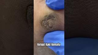 KETUAT KAKI JANGKITAN KUMAN VIRAL WARTS KERAS JADI KEMATU SAKIT  DrMan Ttdi Story [upl. by Hoshi]