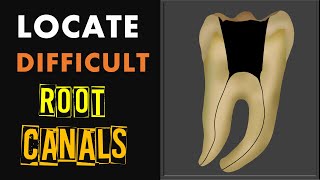 How to locate difficult root canals [upl. by Iney]