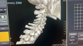 CT Scan C spine  Cervical spine with 3D planning amp procedure discoveryzsm7667 [upl. by Squier636]