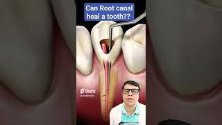 Root canal treatment side effects shorts short youtubeshort rootcanaltreatment [upl. by Xena]