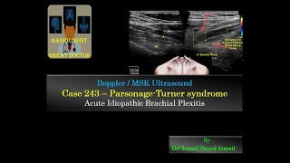 Ultrasound Case 243  Parsonage Turner Syndrome [upl. by Ellyn]