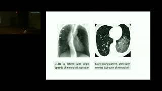 Lipoid Pneumonia An Uncommon Cause Of Pneumonia Dr Pratima Internal Medicine PGIMER [upl. by Emanuele]