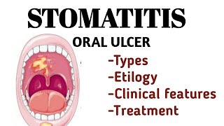 stomatitis मुँह का अल्सर  oral cavity inflammation  oral ulcer Types [upl. by Waligore]