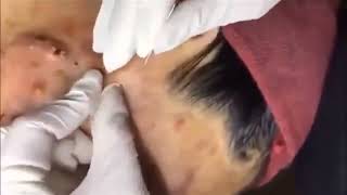 Relax everyday with sac dep spa  blackheads removal [upl. by Bartlett743]