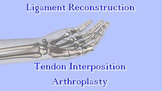 The Anchovy Procedure for Thumb Basal Joint Arthritis [upl. by Dorey]