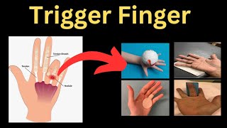 A Complete Guide to Trigger Finger [upl. by Ajup]