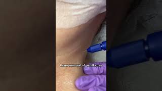 Laser removal of papillomas SOUND ON  IDerm cosmetic studio [upl. by Gwyn]