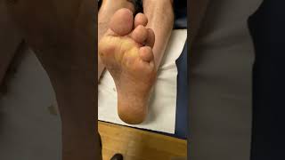 Say goodbye to painful corns Watch our expert podiatrist in action PainFreeFeet CornRemoval [upl. by Adnilreb773]