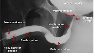 Retrograde Urethrogram  Ascending urethrography [upl. by Aneerb849]