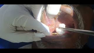 Leukoplakia toungue Cautery Laser  Dr Hitesh Patel [upl. by Tamis604]