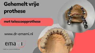 Gehemelte vrije prothese telescoopprothese kunstgebit zonder gehemelte [upl. by Aluap]