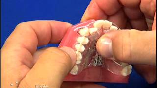 Adams clasp adjustment by Five Star Orthodontic Lab and Supply [upl. by Nnahgiel]