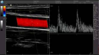 Carotide PWmp4 [upl. by Dante934]