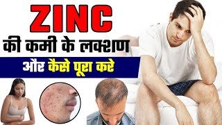 ZINC जिंक की कमी के लक्षण और इलाज  Zinc ki kami se kya hota hai [upl. by Lachance1]