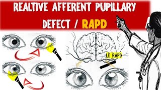 Understanding Relative Afferent Pupillary Defect RAPD amp Marcus Gunn pupil [upl. by Anwahsak304]