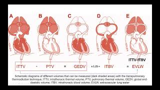 Transpulmonary Thermodilution method Case studies [upl. by Ashwin]