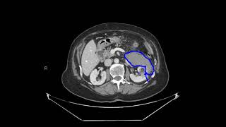 Renal angiomyolipoma with acute hemorrhage [upl. by Enoek]