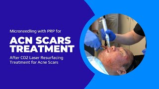 Microneedling with PRP for Acne Scars Treatment After CO2 Laser Resurfacing Treatment for Acne Scars [upl. by Lewison]