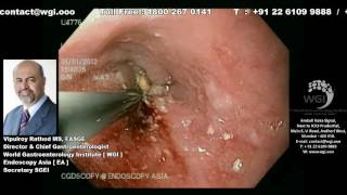 Endoscopic procedure of Esophageal Metal Stenting [upl. by Nidnerb]