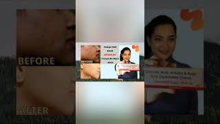 How to use demelan cream 🥰💯🙏shortvideo ytshorts shorts [upl. by Waldemar]