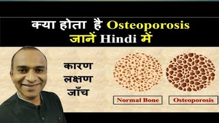 Osteoporosis kyu hota hai Osteoporosis ka ilaz kya hai All about Osteoporosis [upl. by Lynd214]