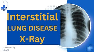 Interstitial Lung Disease Radiology Interstitial Lung Disease Chest X Ray [upl. by Digdirb105]