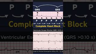 Third Degree Atrioventricular Block ECG Ventricular Escape Rhythm [upl. by Ardith245]