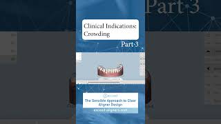 Clinical Indications Crowding Part 3 [upl. by Erdman]